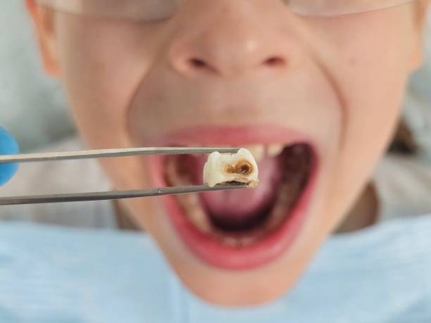 Best Emergency Root Canal Treatment in Azle, TX