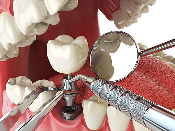 Best Emergency Tooth Extraction in Azle, TX