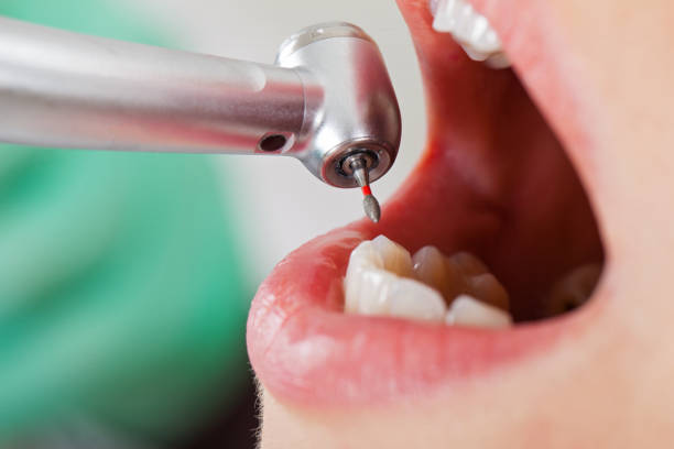 Best Emergency Dental Care for Broken or Chipped Teeth in Azle, TX
